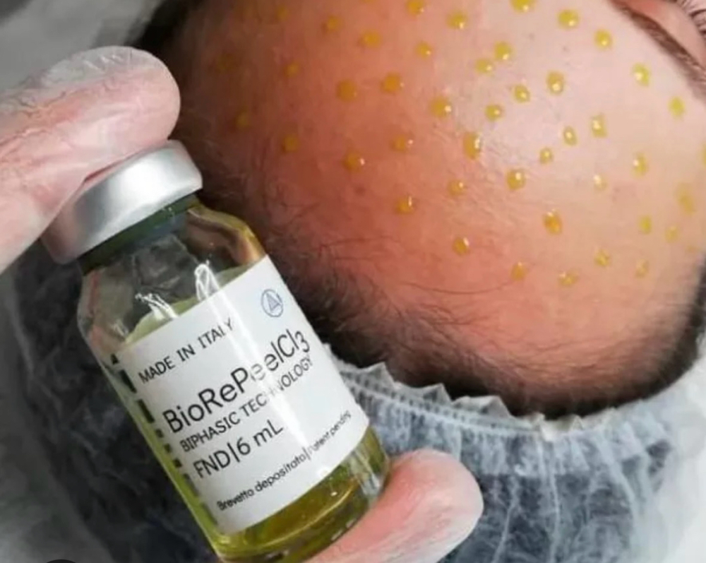 BioRePeel+Dermaplaning at 🤍pSb Luxe Beauty🤍 in Tottenville, NY