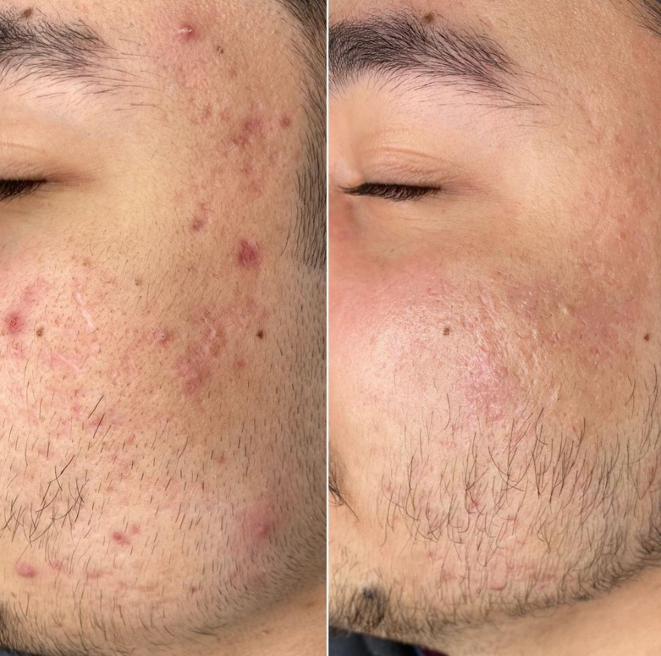 Microneedling ( Face Only )