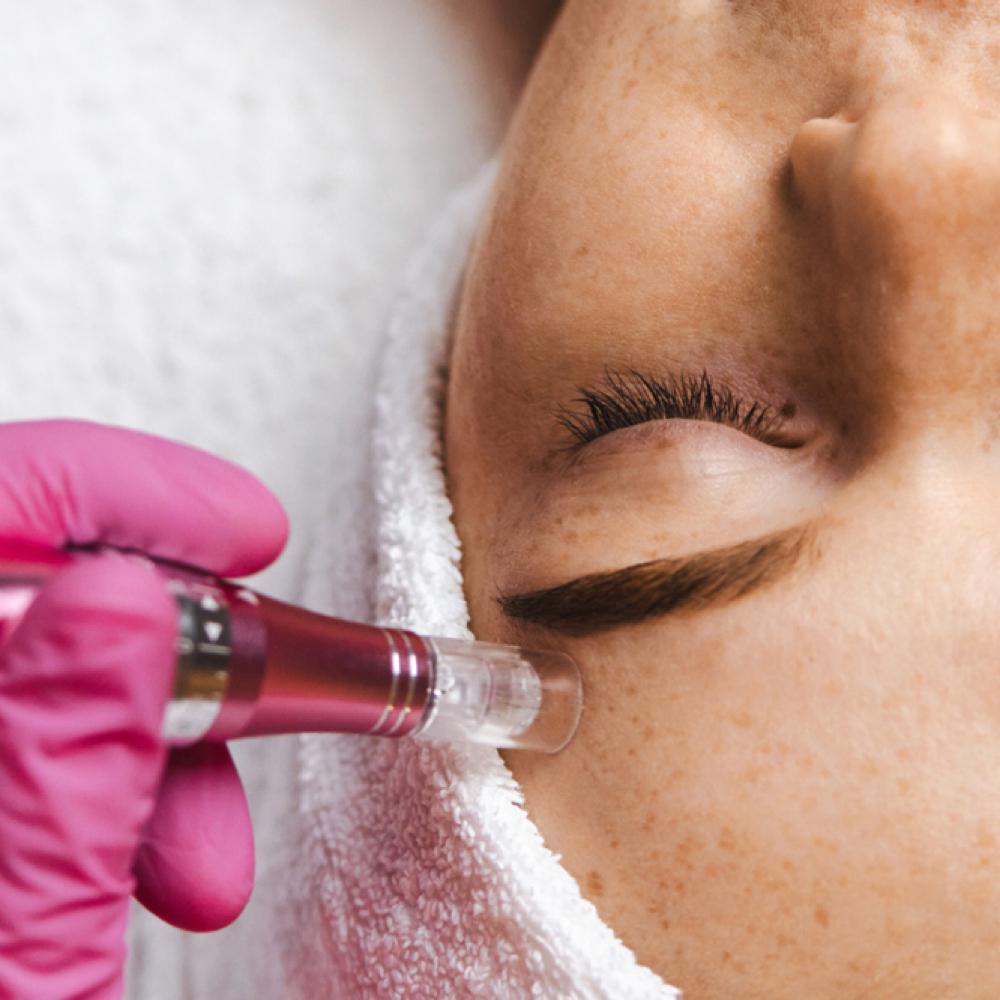 Micro-Channeling at Skinrevivalco in San Diego, CA