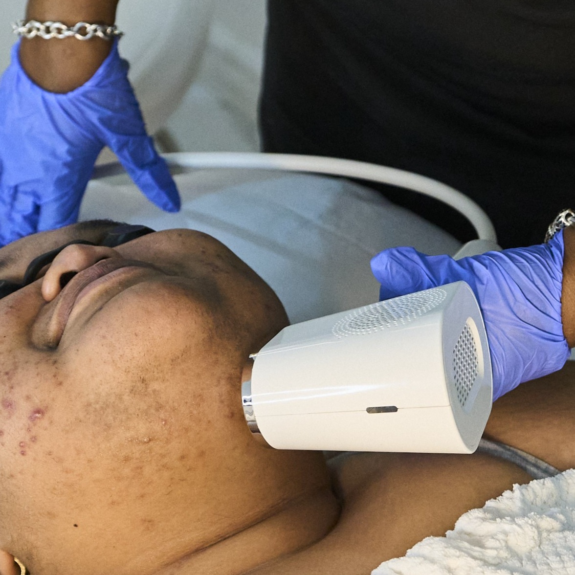 IPL Laser Treatment at Zen Essence Spa & Wellness in Brooklyn, NY