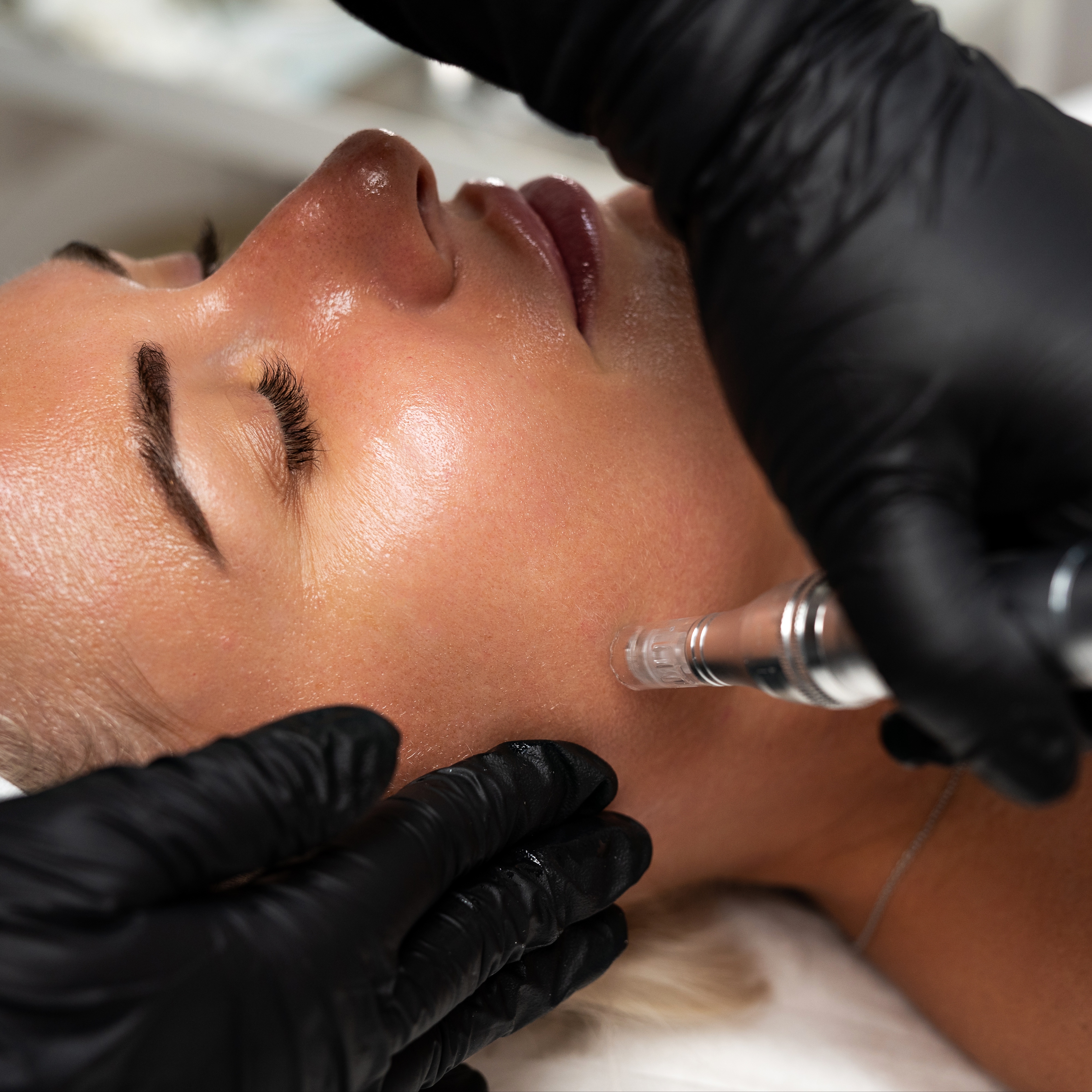 Nano Skin Renewal+ (nano-needling) at VIDAMIN+ SKIN CARE in ORANGE PARK, FL