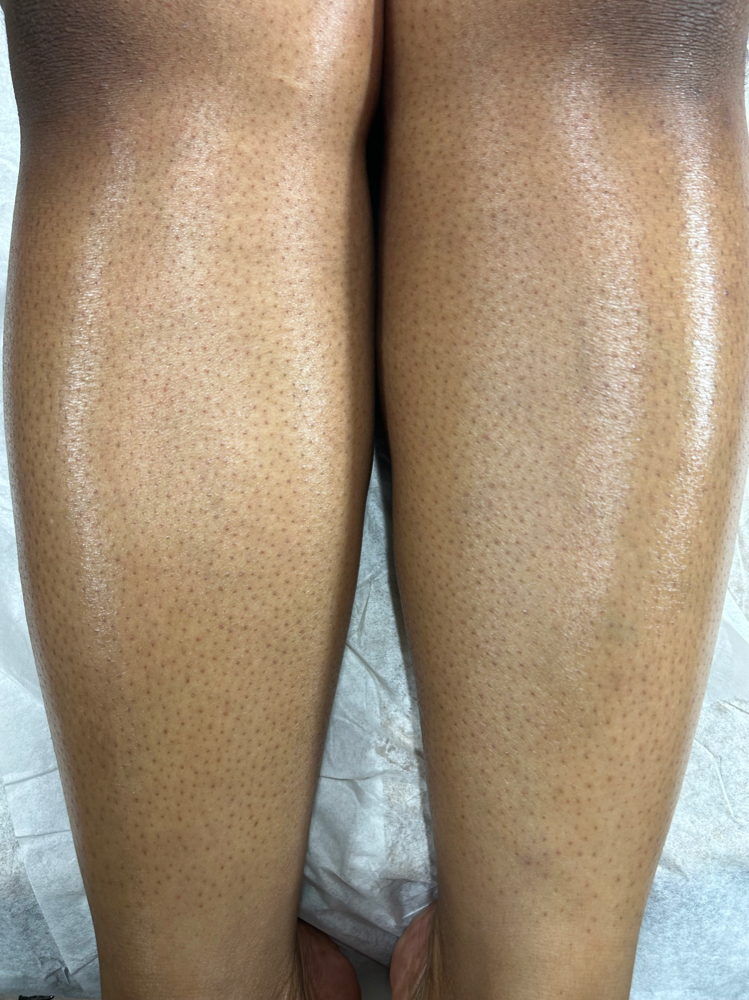 Lower Leg