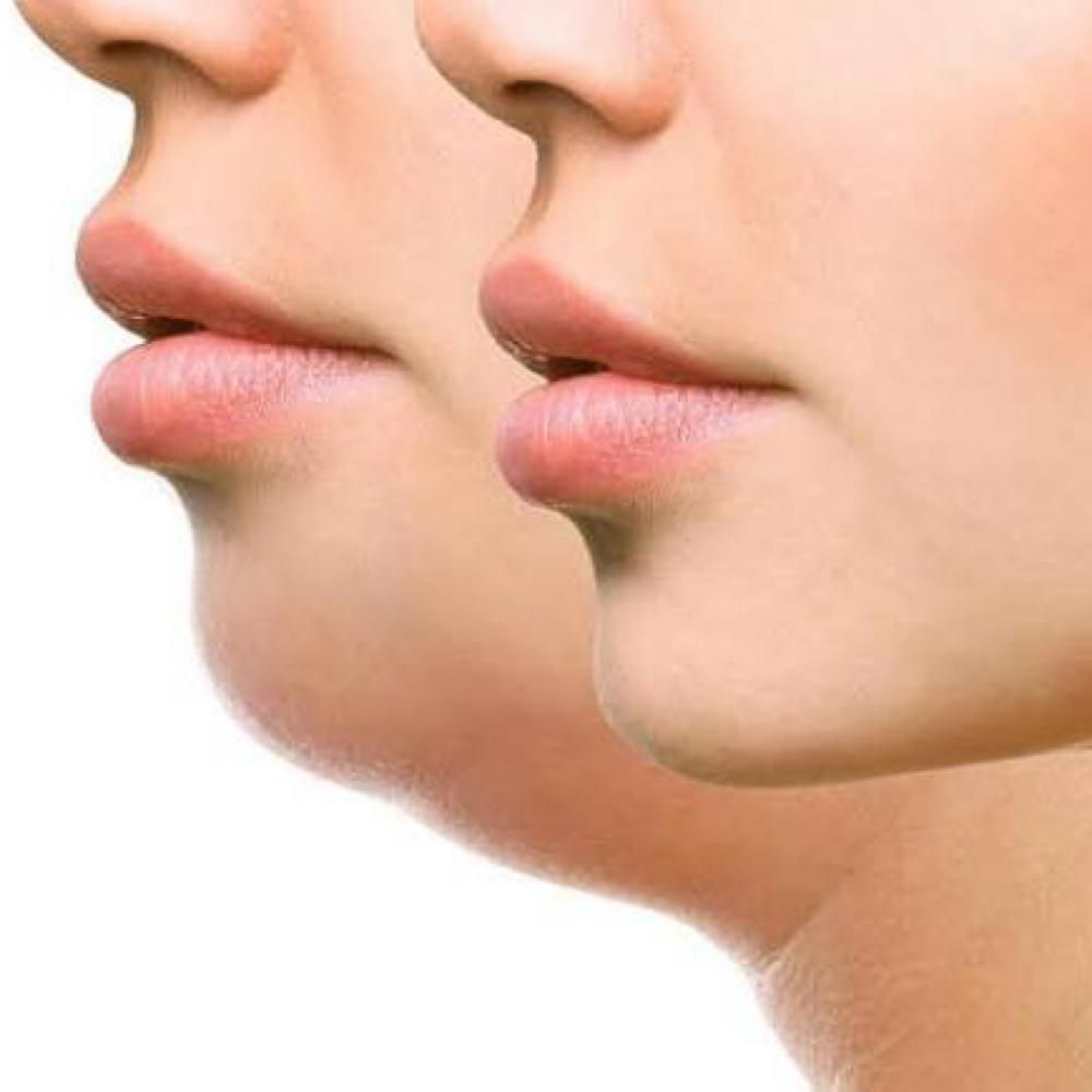Double Chin Reduction (RF) Packages at WaxLand & BodySculpting in Los Angeles, CA