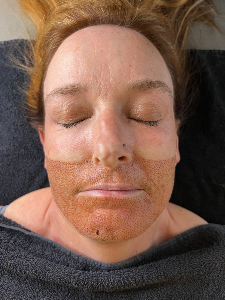 Fibroblast plasma Lift- Mouth Area