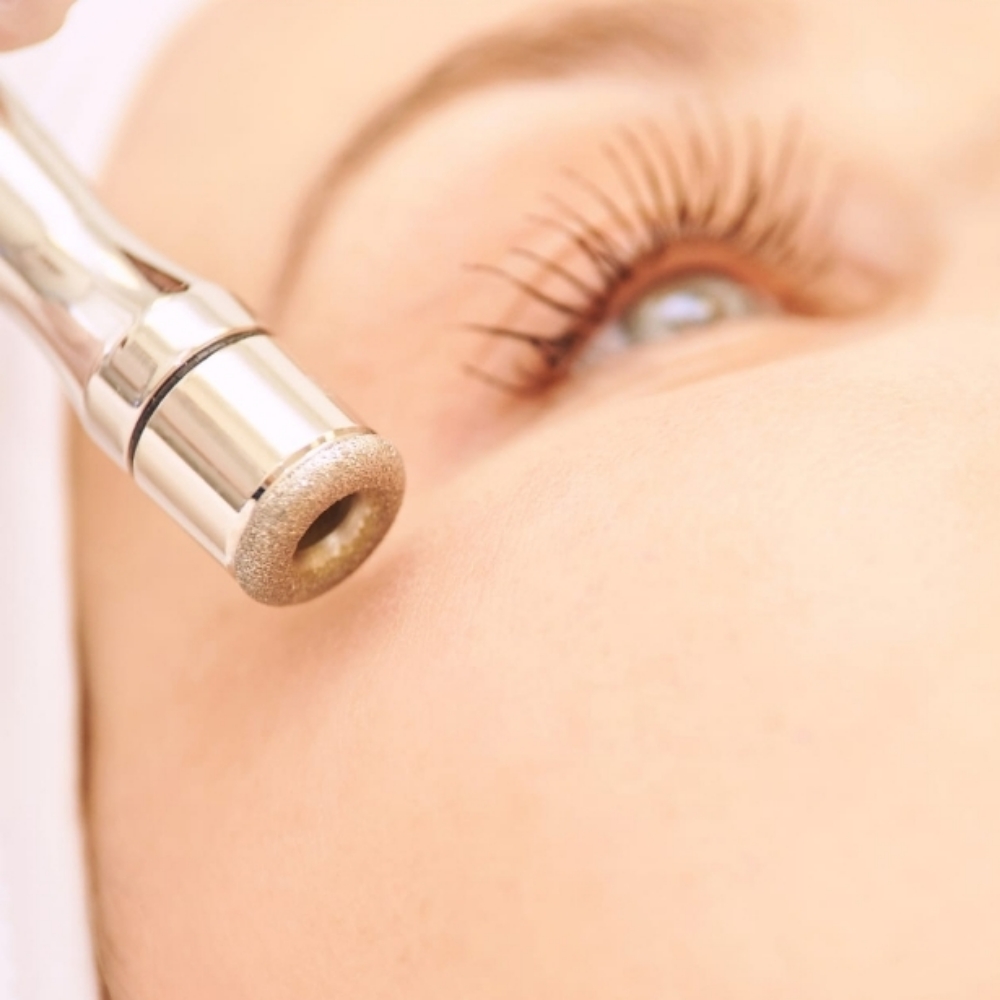 Microdermabrasion Treatment at Glow by Mitzi in Milford, CT