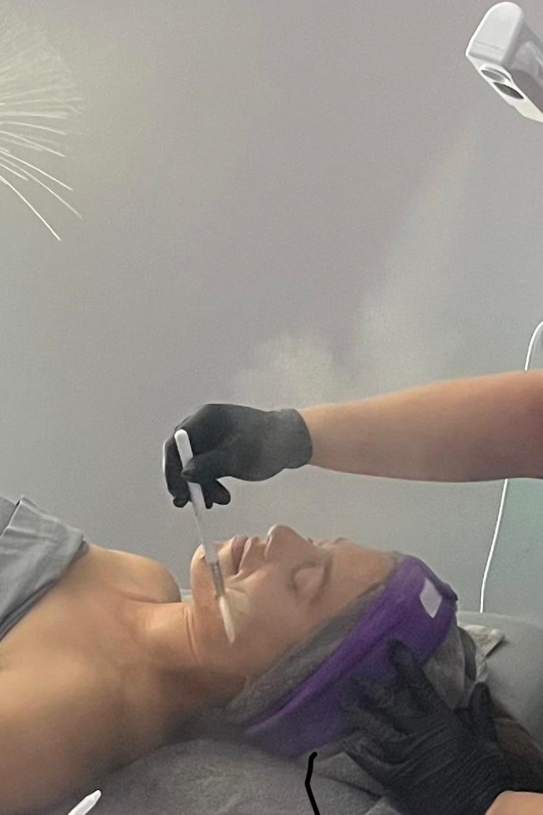 Exfoliation or peeling