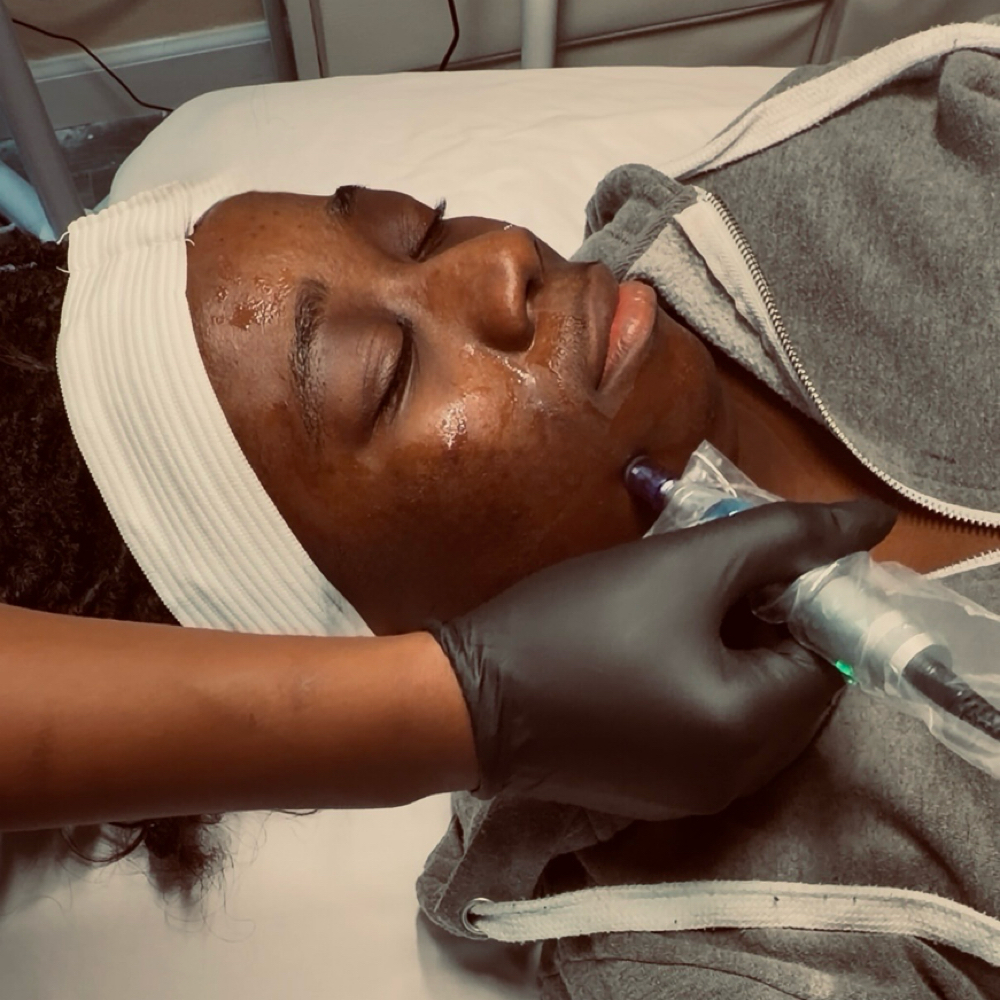 Microneedling at Refinery Aesthetics Loft in Oxon Hill, MD