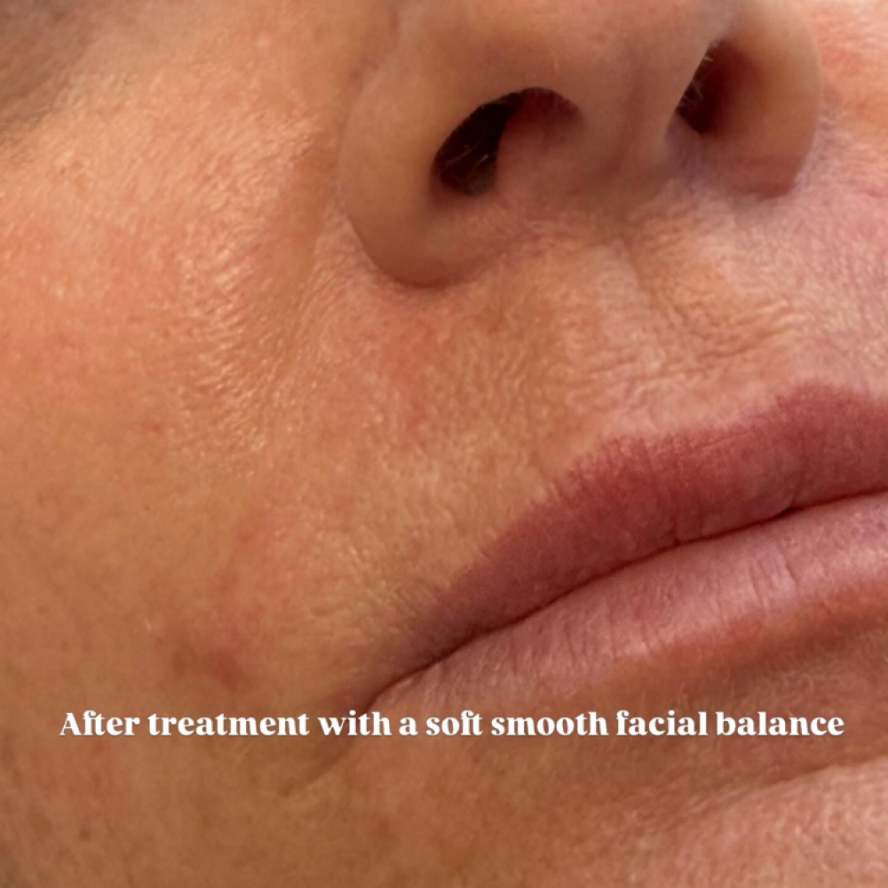 Nasal Labial Folds Filler at Lc Beauty Vault in Sinton, TX