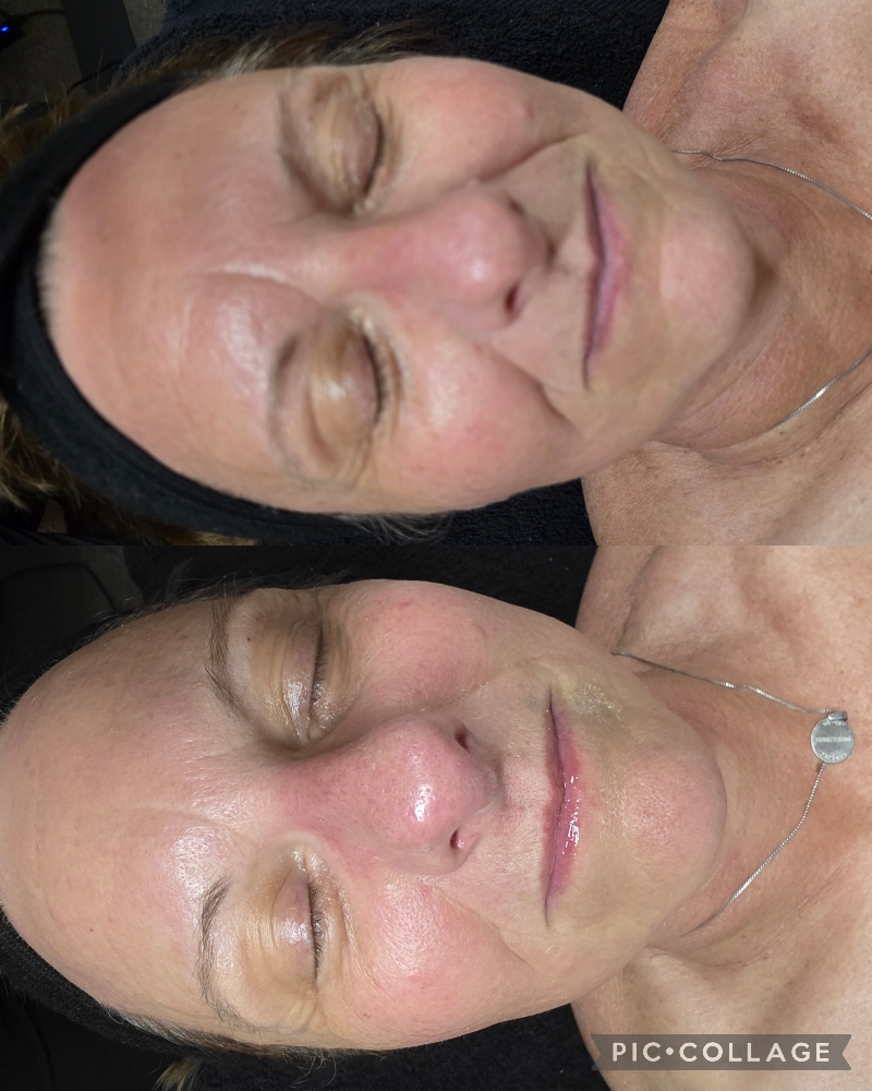 Beyond Botox Age Rewind Facial