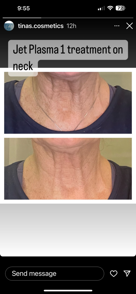Neck Add On