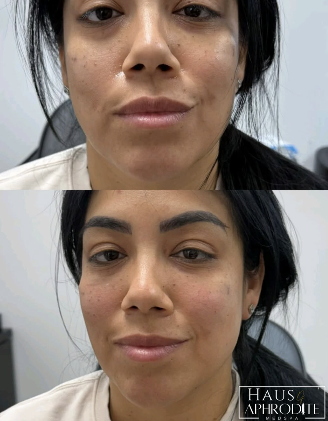 Undereye Filler