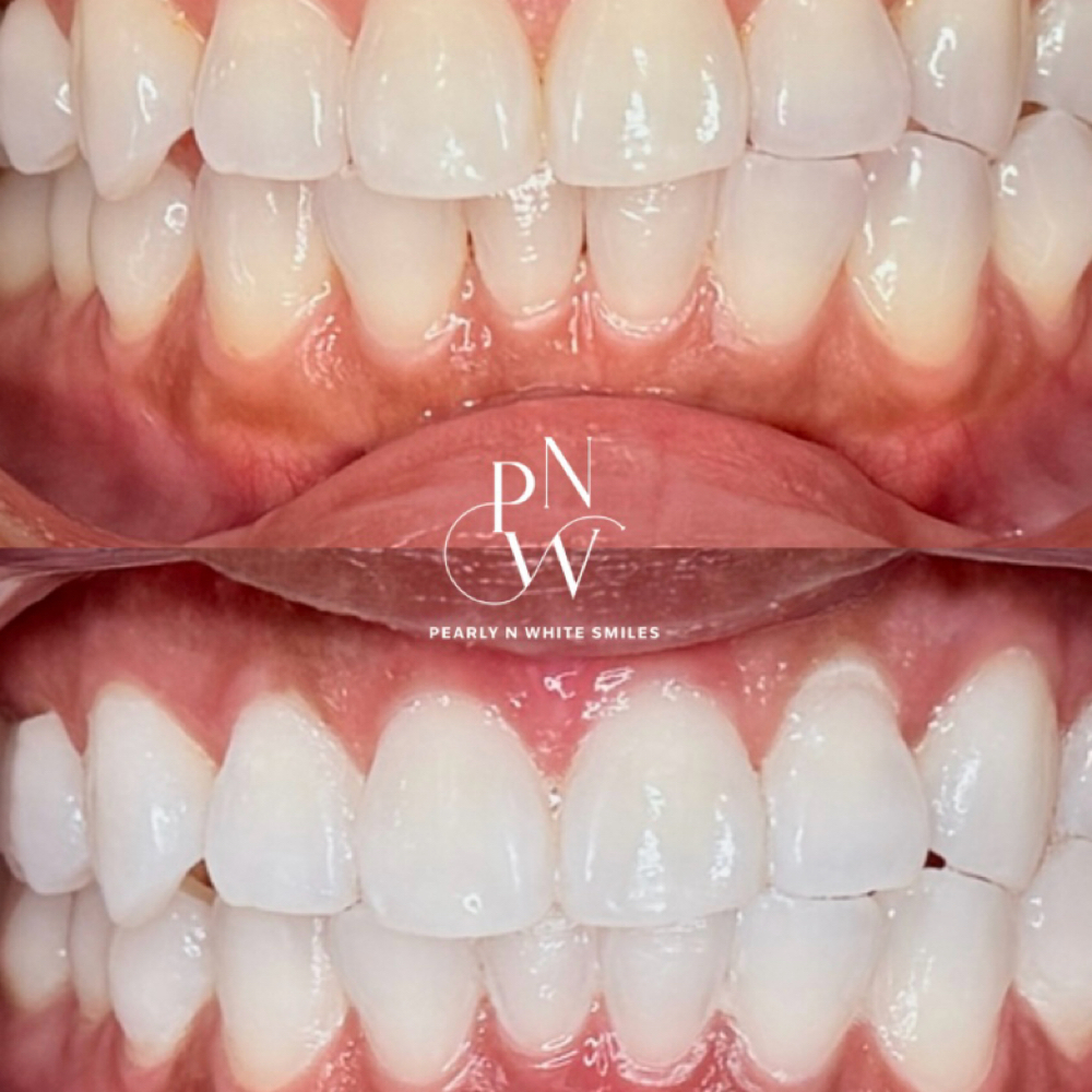 $99 Special at Pearly N White Smiles in Salem, OR
