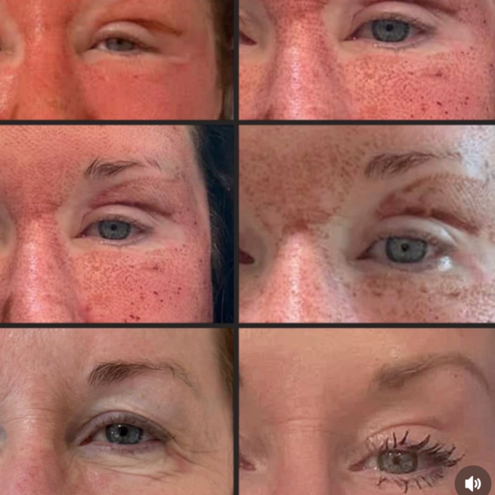 Fibroblast SPECIAL at Lash + Skin RX in Concord, NC