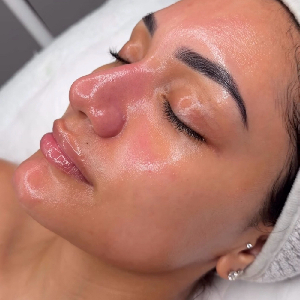 Microneedling + BioRepeel at Marta Rabelo Skin & Laser in Malden, MA