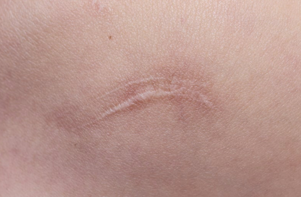 Scar Revision - (Med-Large)