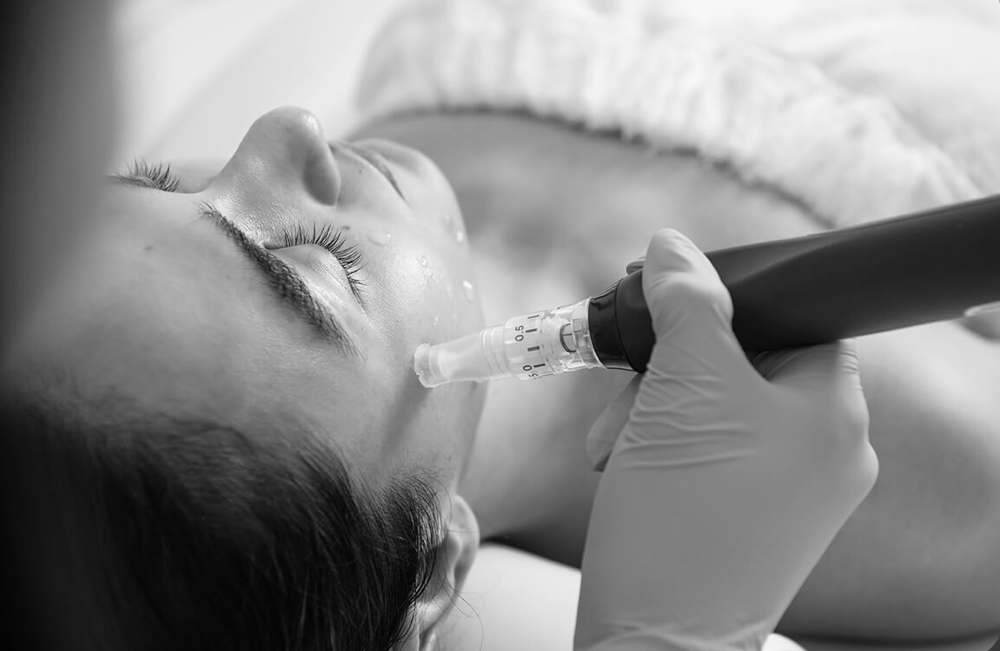 Microneedling