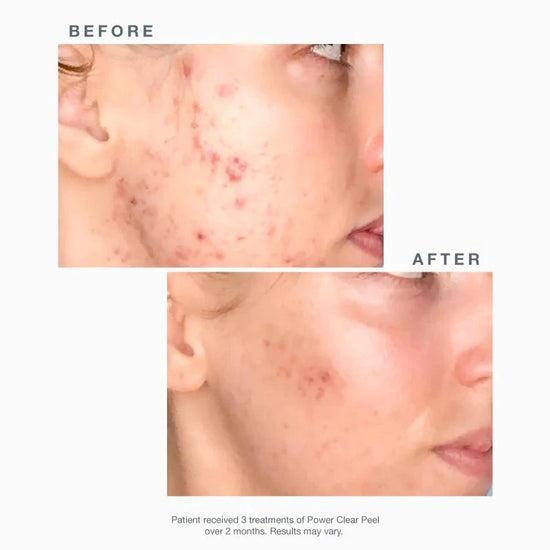 Acne Clarifying Peel