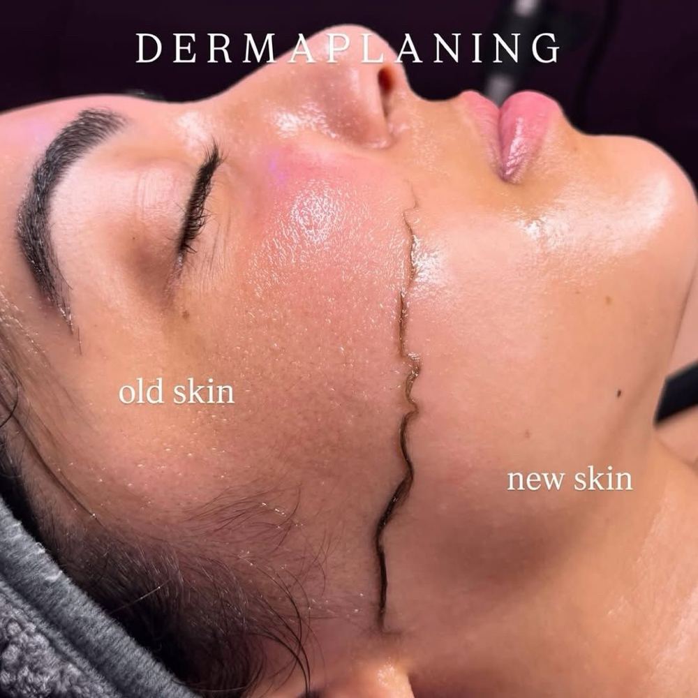 Dermaplane ~ADD ON~ at Radiant Skin By Katrina in Bradenton, FL