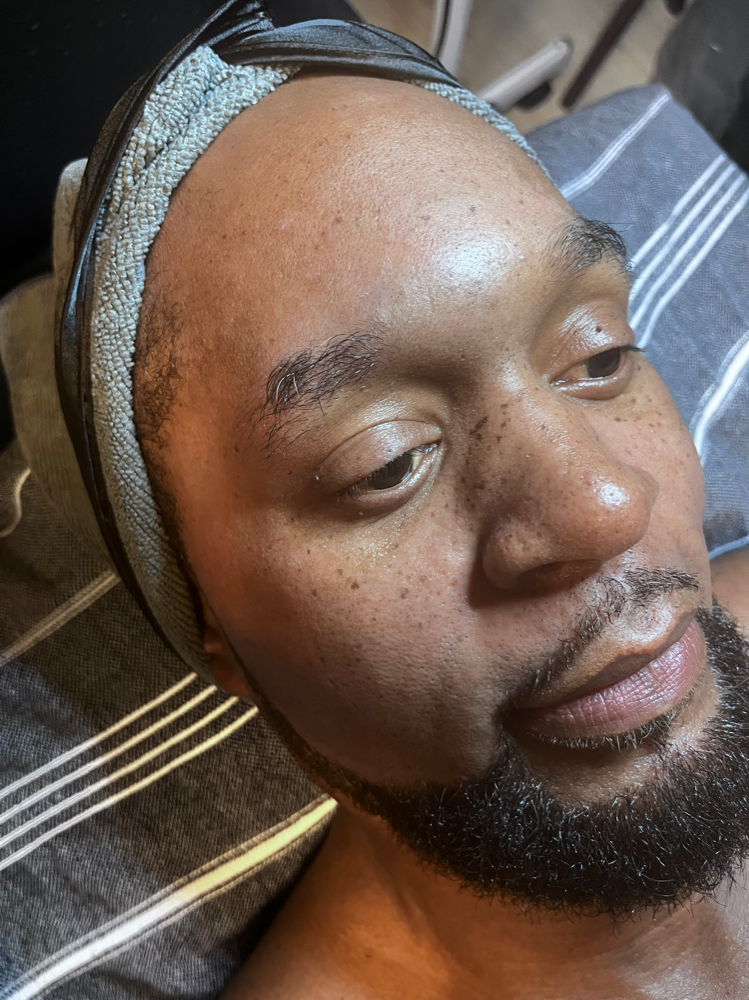 Microdermabrasion (Face Only)