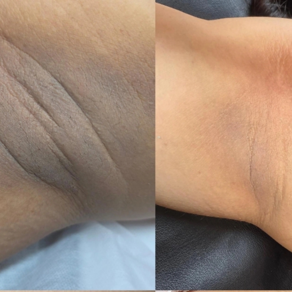 Body Peel at SUBLIME BEAUTY STUDIO in MONTEREY, CA