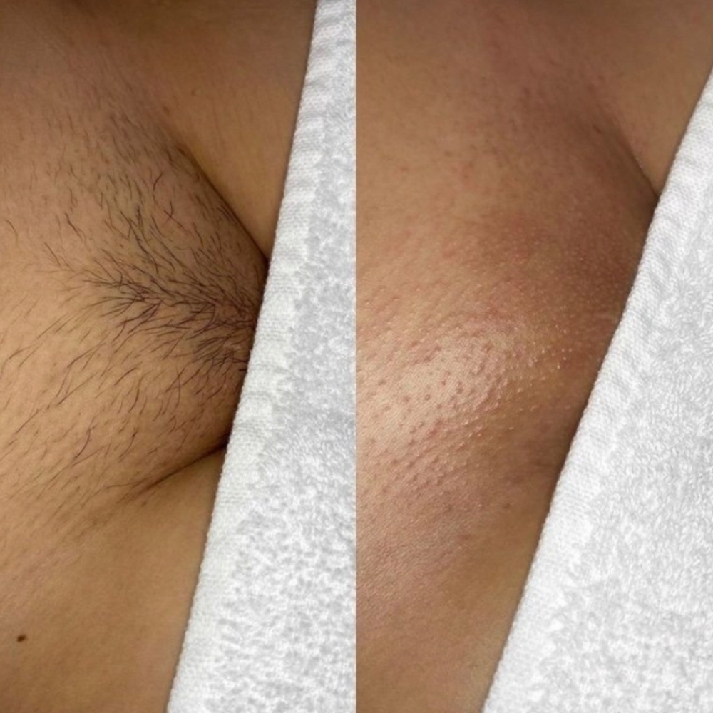 Bikini Full at Belladonna Beauty Waxing & Skincare By Chelsea in Greenville, TX