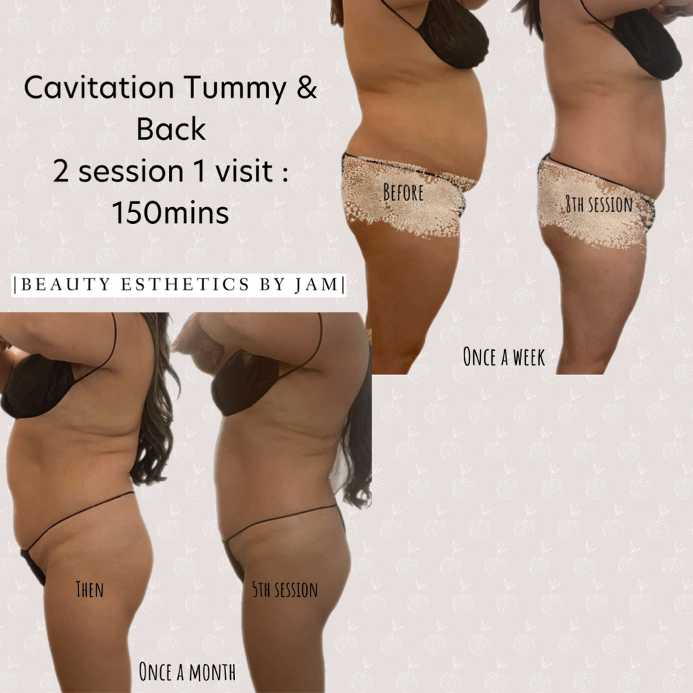 Body cavitation skin tightening