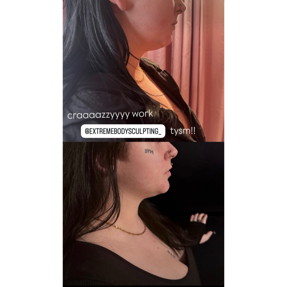 Liquid Lipo Chin