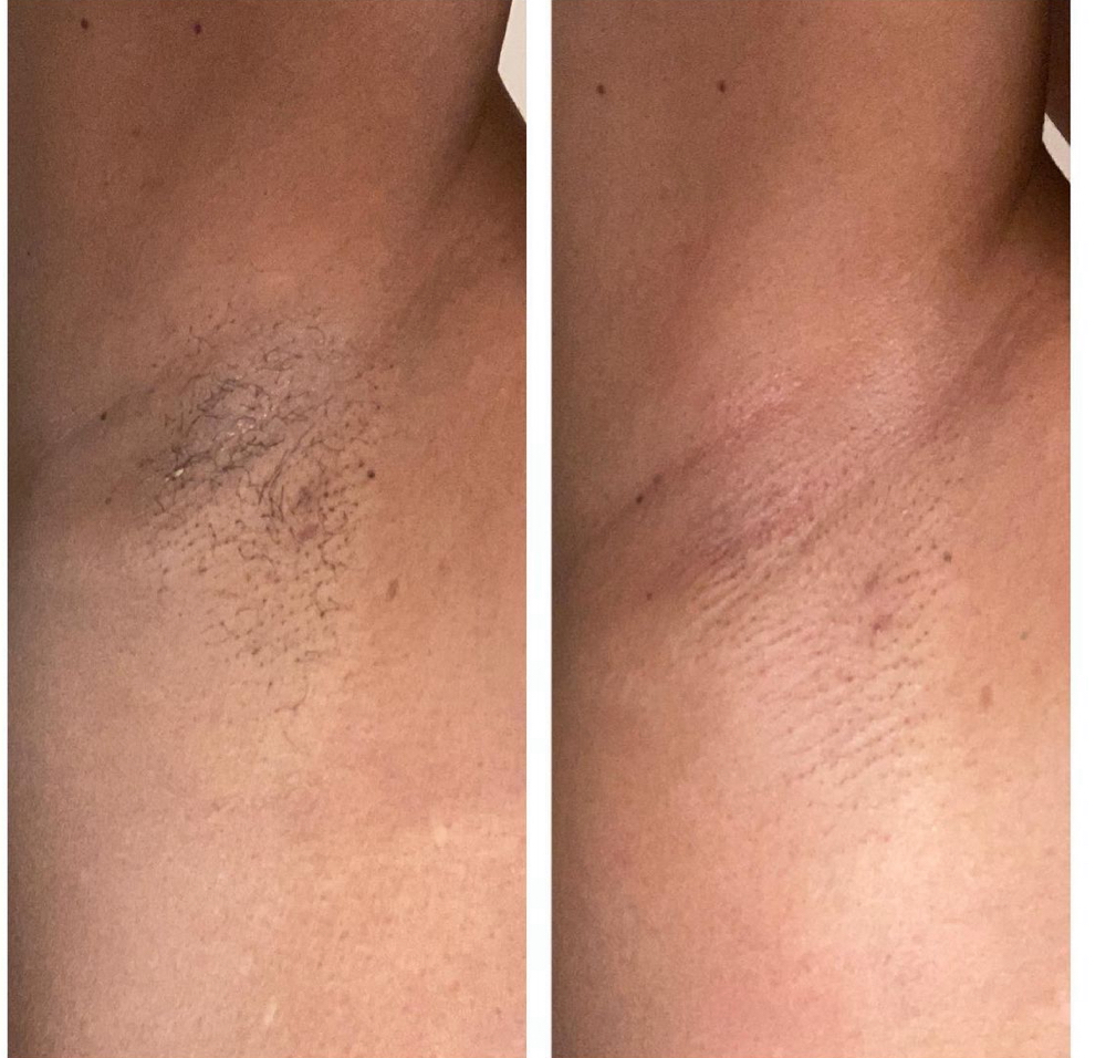 Underarms
