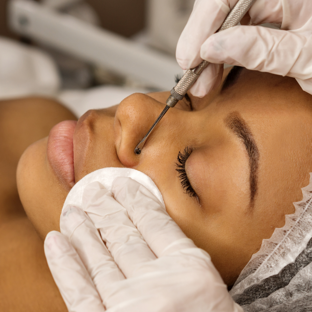 Acne Facial