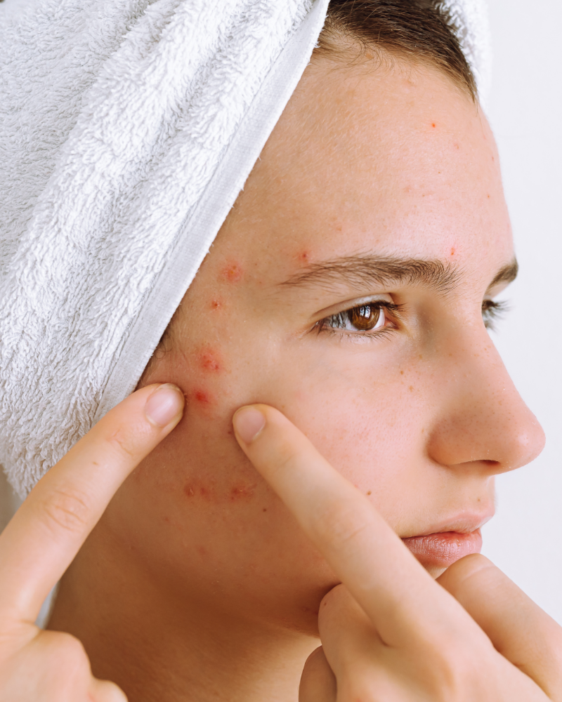 Acne Facial