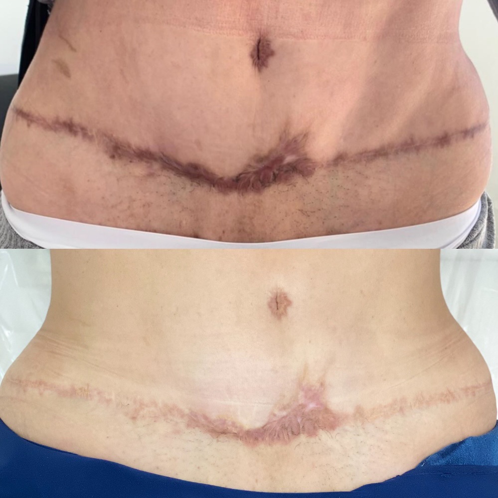 Reconstrucción de Cicatrices at PRIVÉ in Carolina, PR