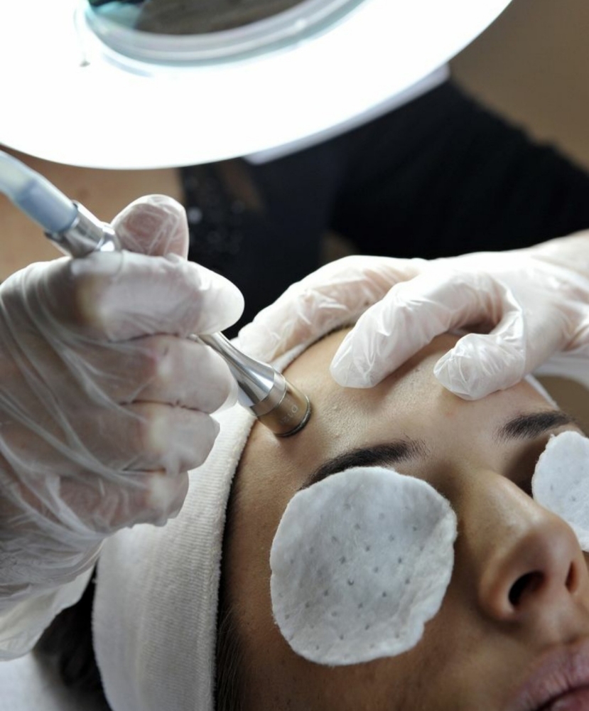 Facial Microdermabrasion