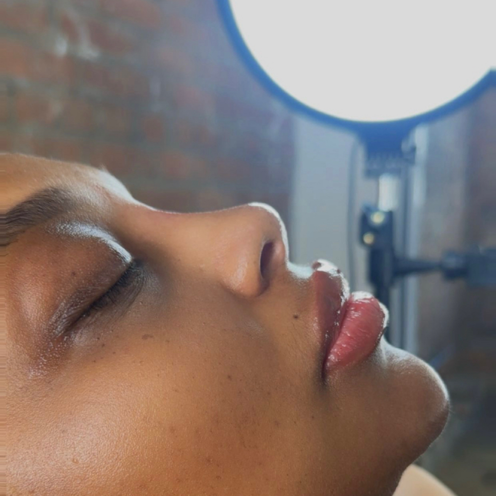 RHINOPLASTY - NON-SURGICAL NOSEJOB at Sabrina Star in Dallas, TX