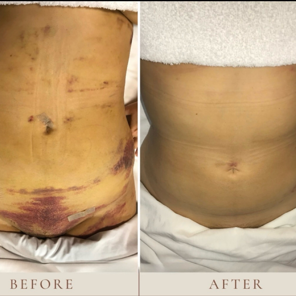 Post-Op Massage After Tummy Tuck & at Ruby’s Beauty Bar in Davenport, FL