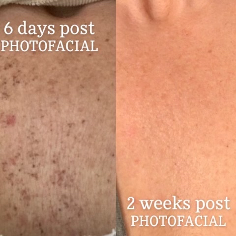 Red Or Brown Spot Treatment at Amy Donaldson Nurse Injector in Westport, MA