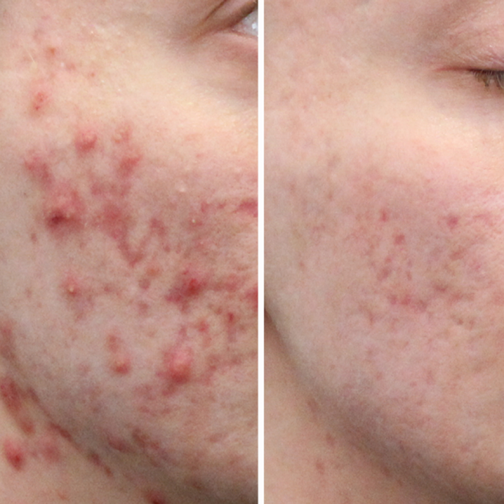 Follow-Up Acne Bootcamp Treatment at Tavaj Esthetics in Sewell, NJ