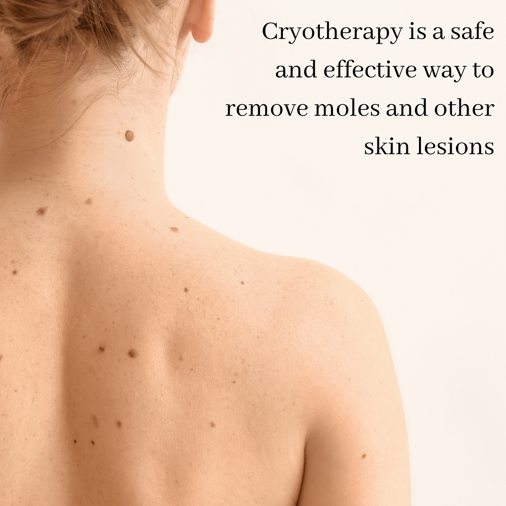 Skin tag removal