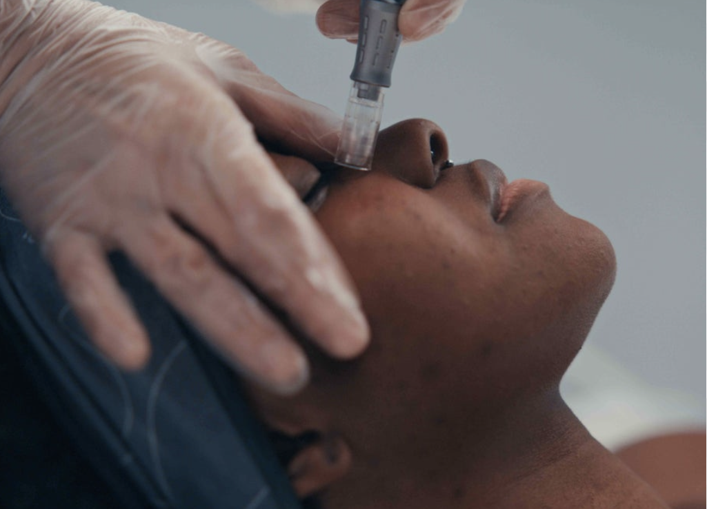 Pro Nanoneedling Facial