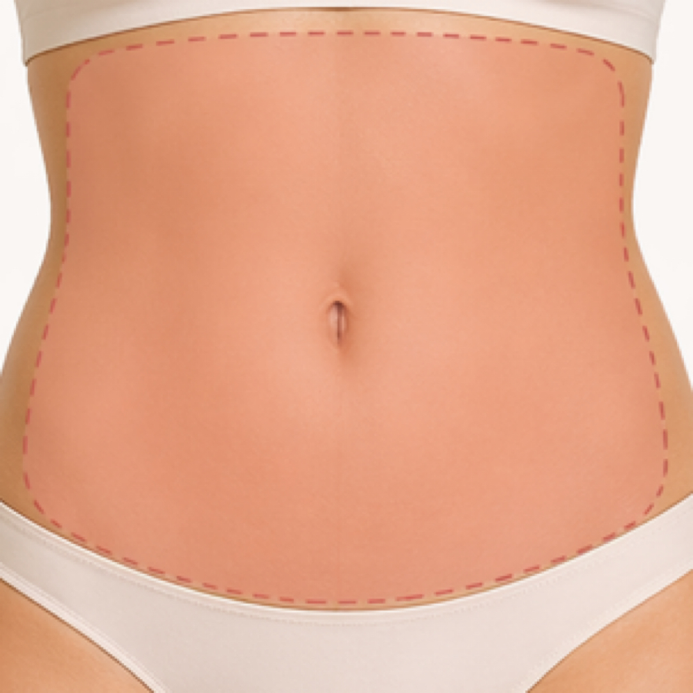 Full Abdominal Renewal (Full area) at Deluxe Beauty Bar in Orem, UT