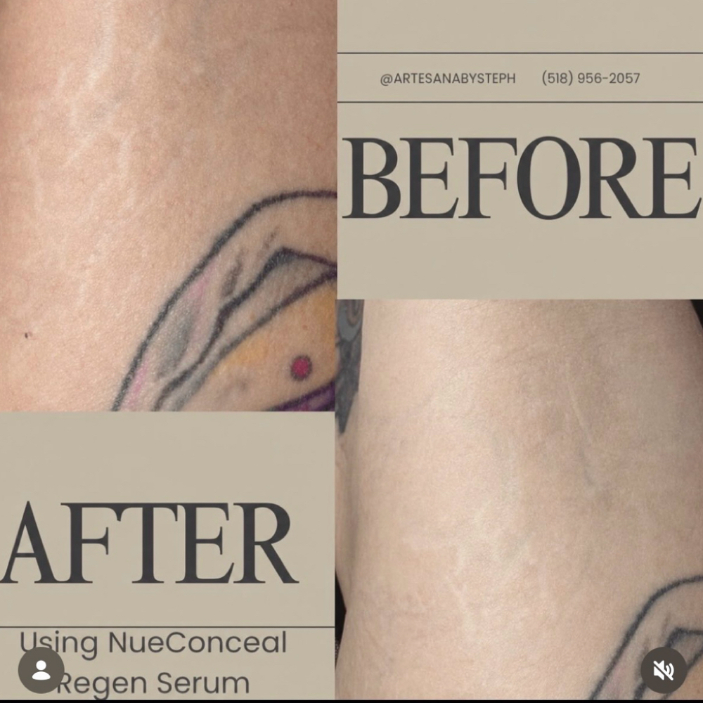 Microneedling Tush&Thighs at ArteSana by Steph in Altamont, NY