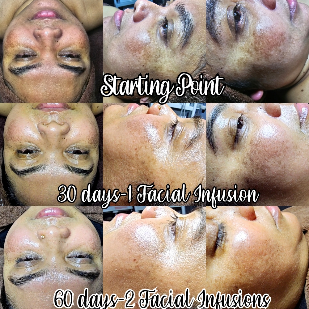 Osmosis Facial Infusion(3 Series)