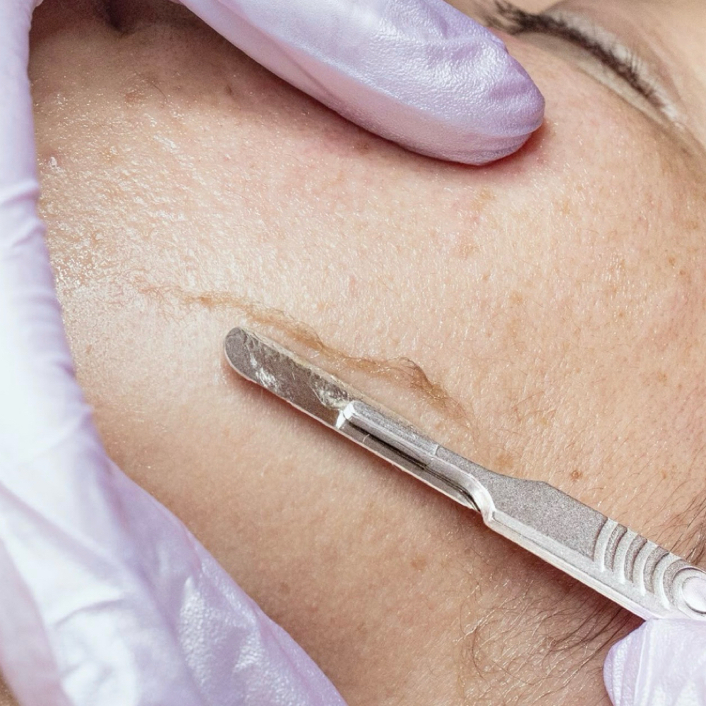 Dermaplaning at SR Beauty Studios in Sacramento, CA