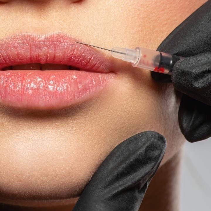 Lip Filler at Injection Fix & Wellness LLC in Amarillo, TX