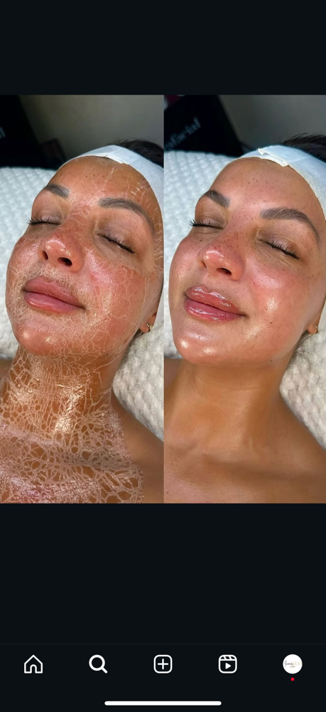 Beyond Botox Facial
