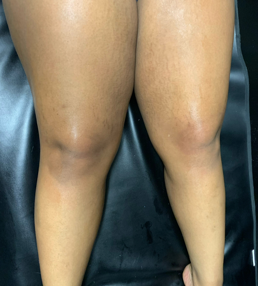 Upper Leg Wax