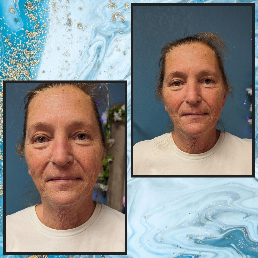 Facelift Facial