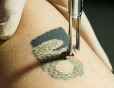 Tatto Removel Smal