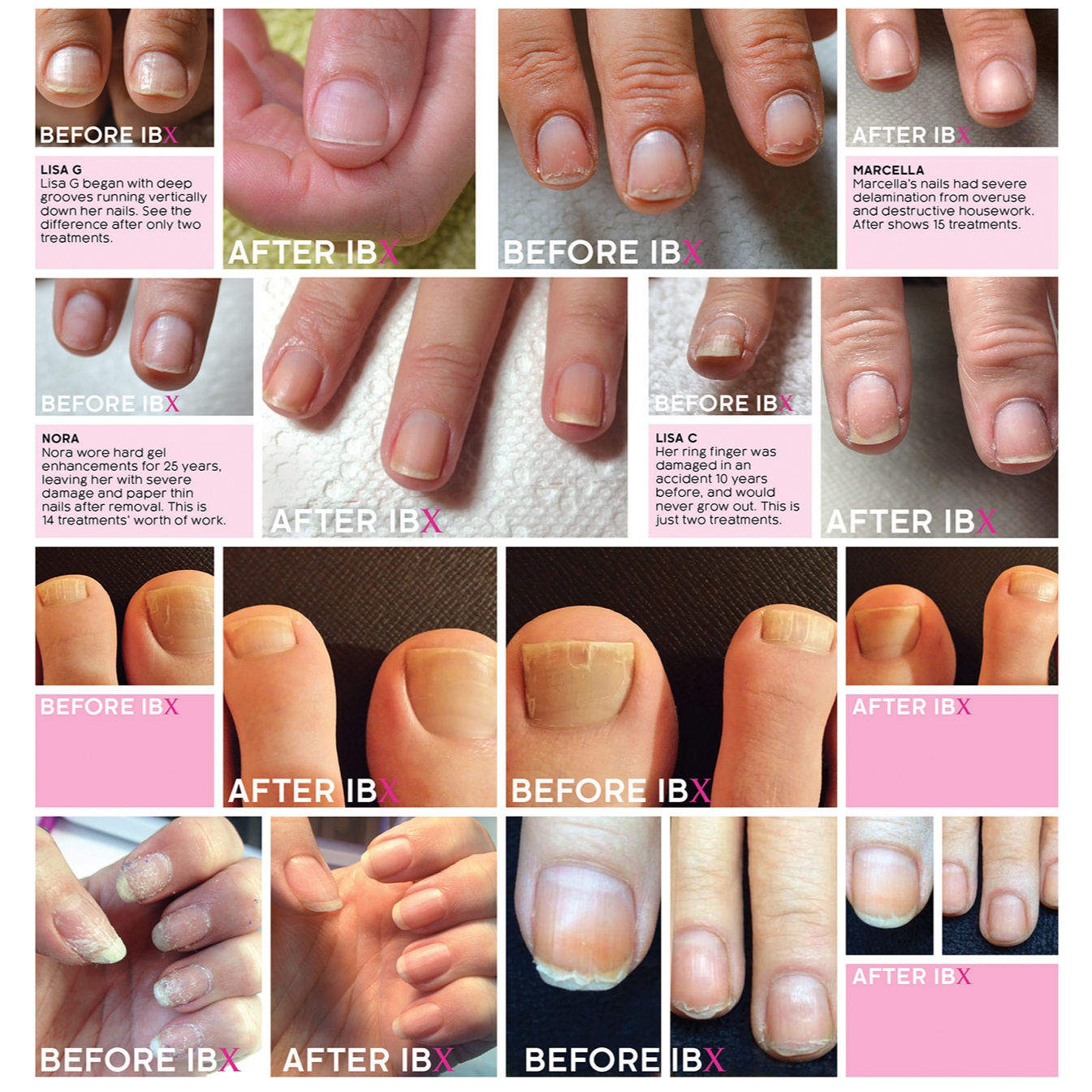 Nail Repair (IBX) Models Toes at The Gloss Junkie in Mooresville, NC
