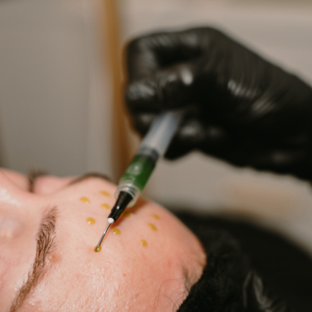 Advanced Biorepeel Treatment at Skin By T Aesthetics in Waterford Works, NJ