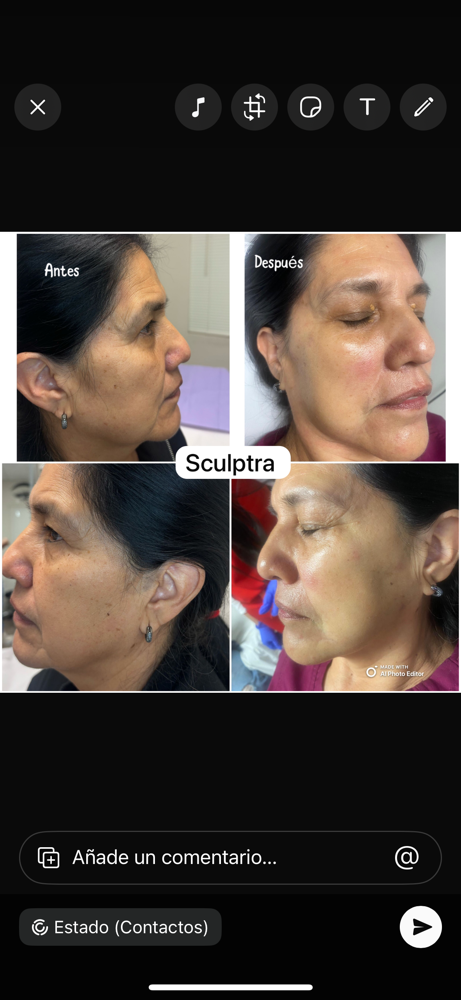 Sculptra